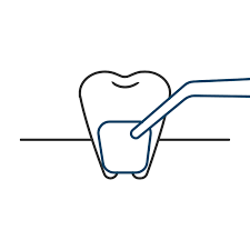Gum Grafting Gum Grafting